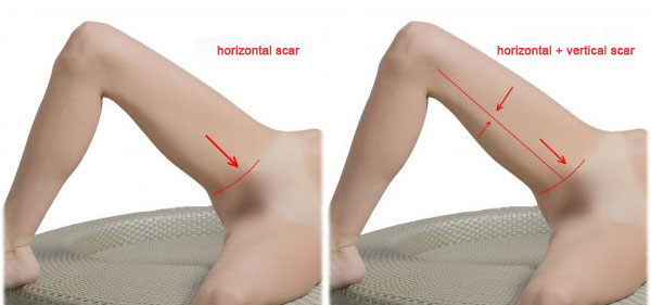 Thigh-lift-scars